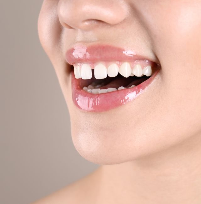 bioclear-treatment-greenline-dental-coquitlam