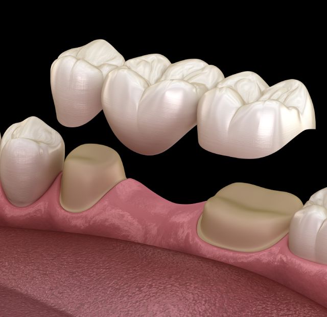 dental-bridges-greenline-dental-coquitlam