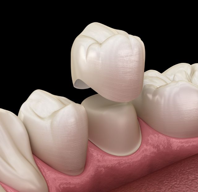 dental-crowns-at-greenline-coquitlam