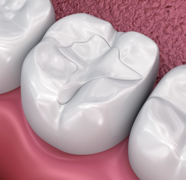 dental-fillings-greenline-dental-coquitlam