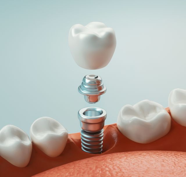 dental-implants-greenline-dental-coquitlam