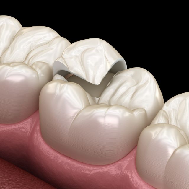 onlays-inlays-at-greenline-dental-coquitlam