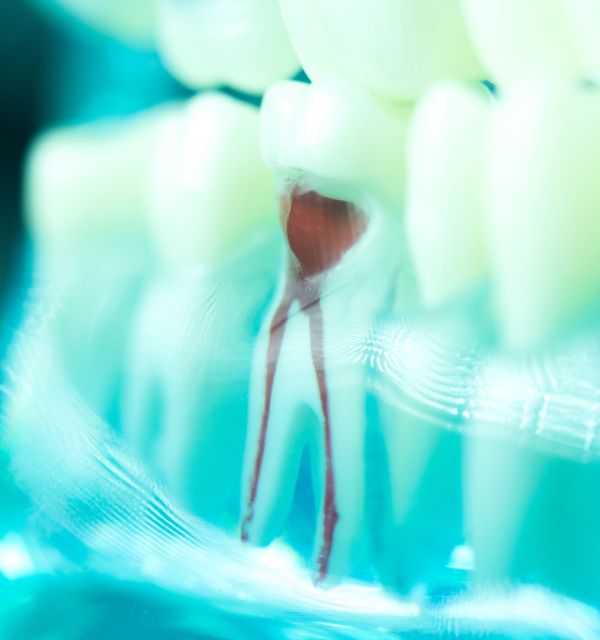 root-canal-tooth-extraction-at-greenline-coquitlam