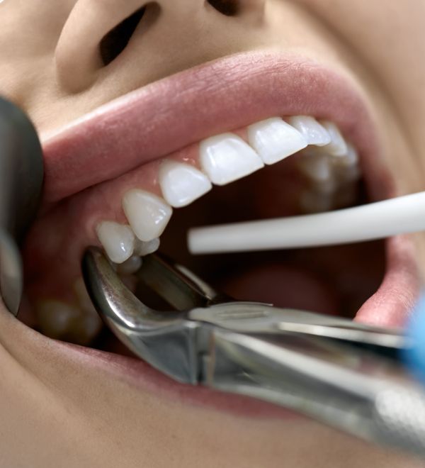 tooth-extraction-at-greenline-coquitlam